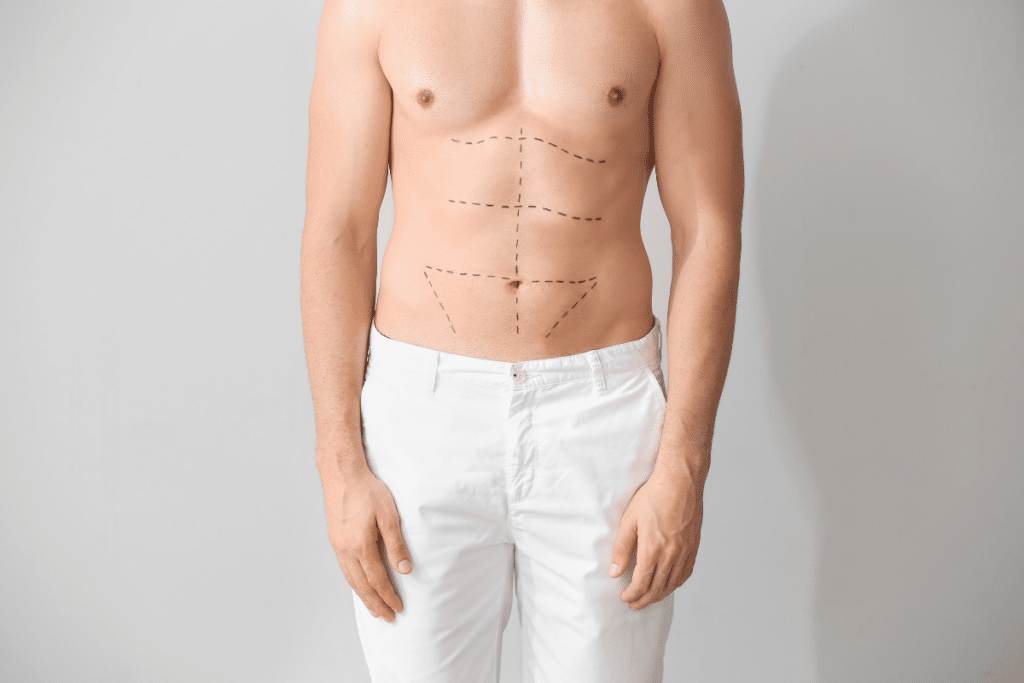 Abdominoplastia.